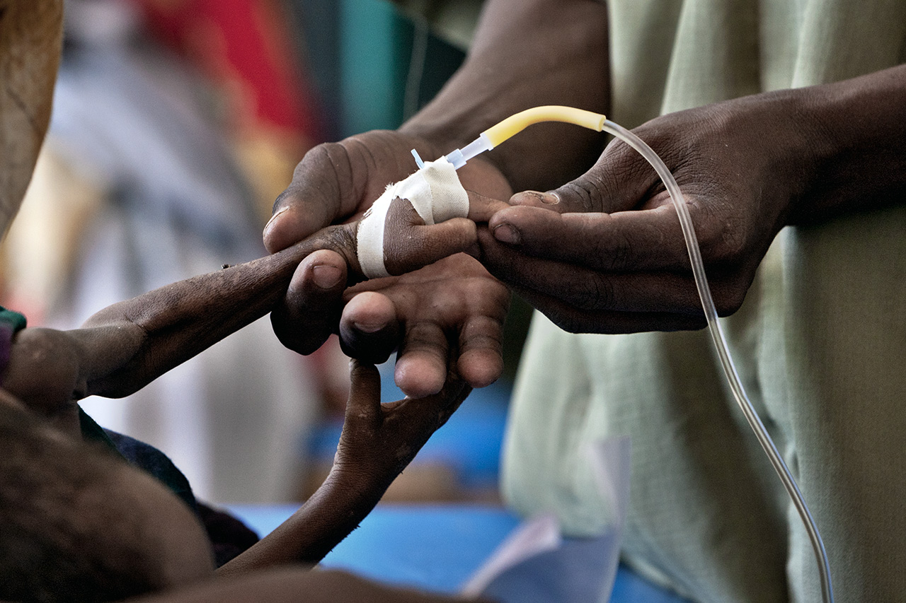 Folgen der Dürrekatastrophe in Somalia: Dieses Flüchtlingskind leidet an Diarrhöe. Photo: Christoph Püschner/Der Spiegel